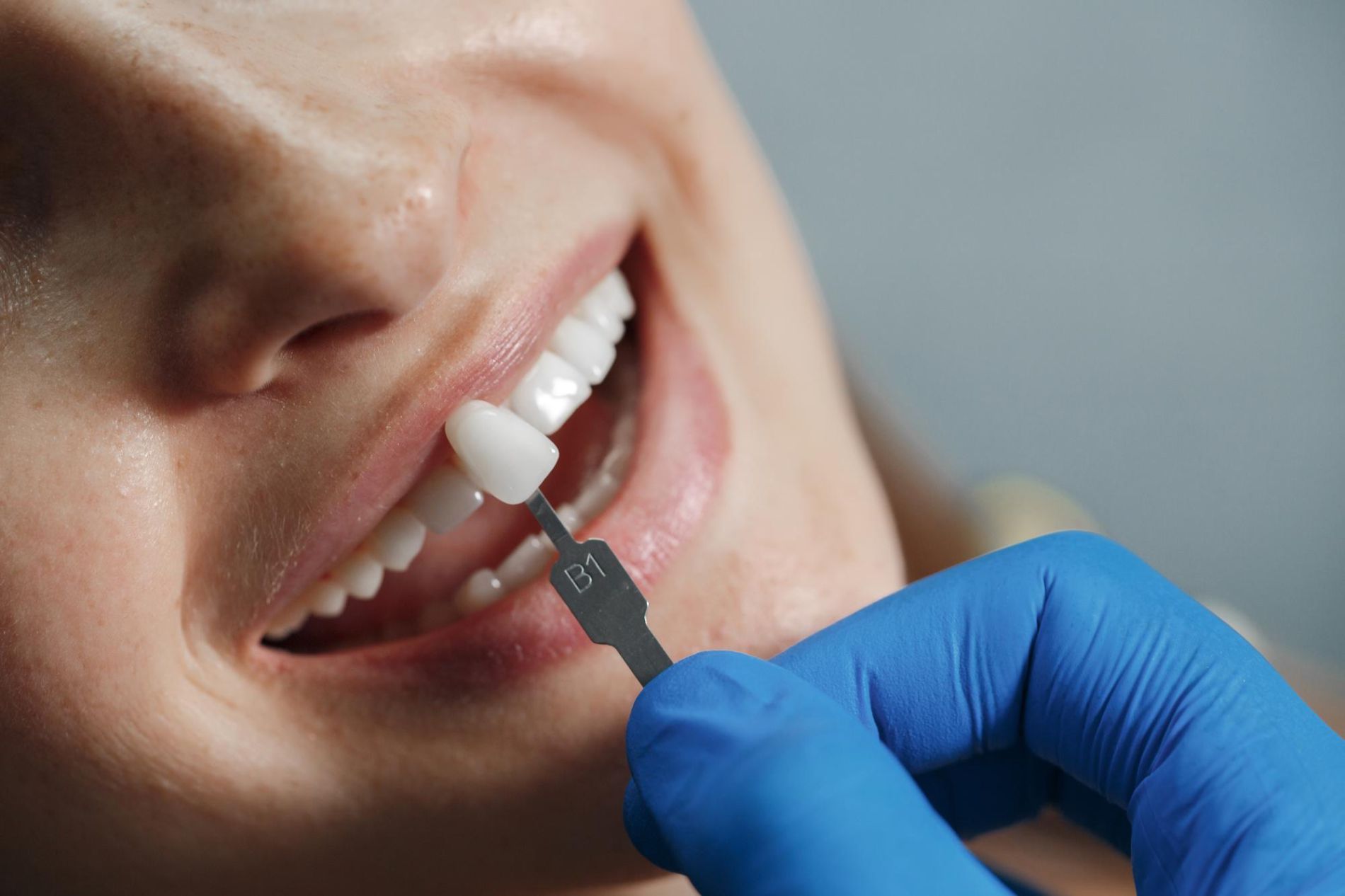 Are Laminate Veneers a Good Choice for a Smile Makeover?