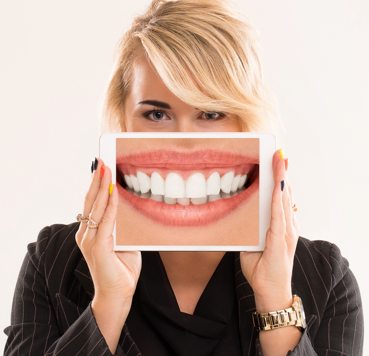 Are Laminate Veneers Worth the Investment for Your Smile?