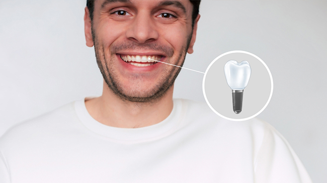 The Ultimate Guide to Dental Implants: Smile with Confidence