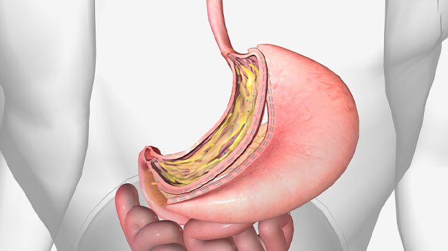 Gastric Sleeve Surgery in Turkey: What You Need to Know