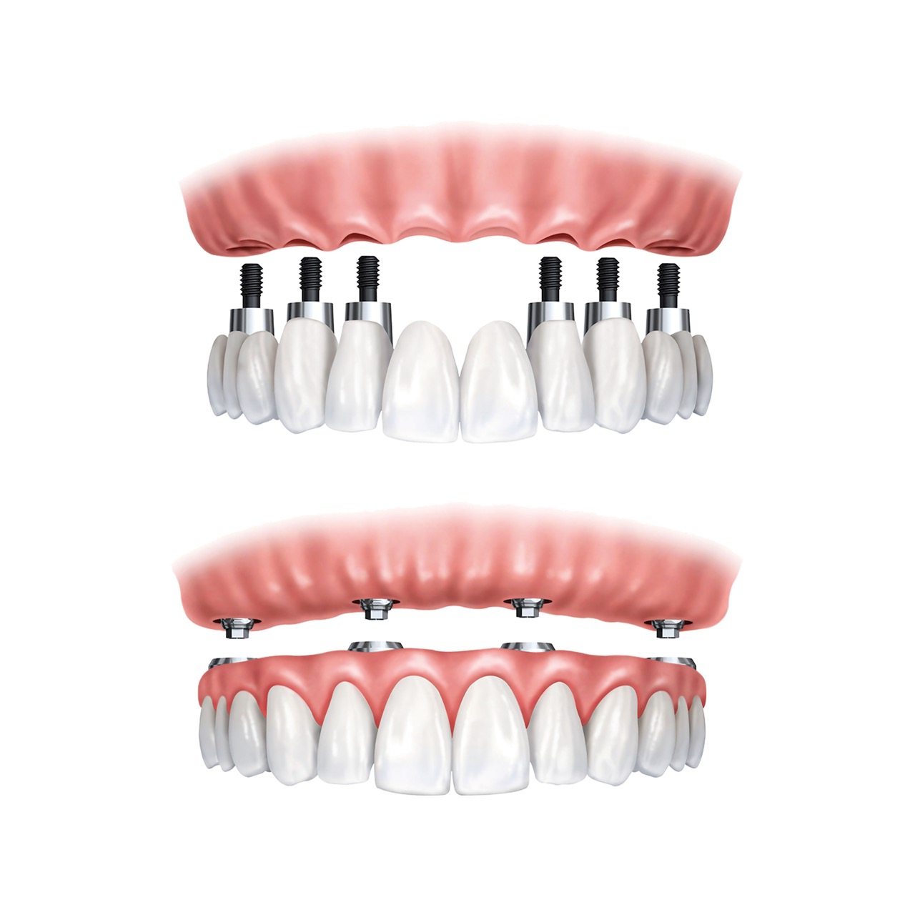 All-on-6 Dental Implants in Turkey: Everything You Need to Know