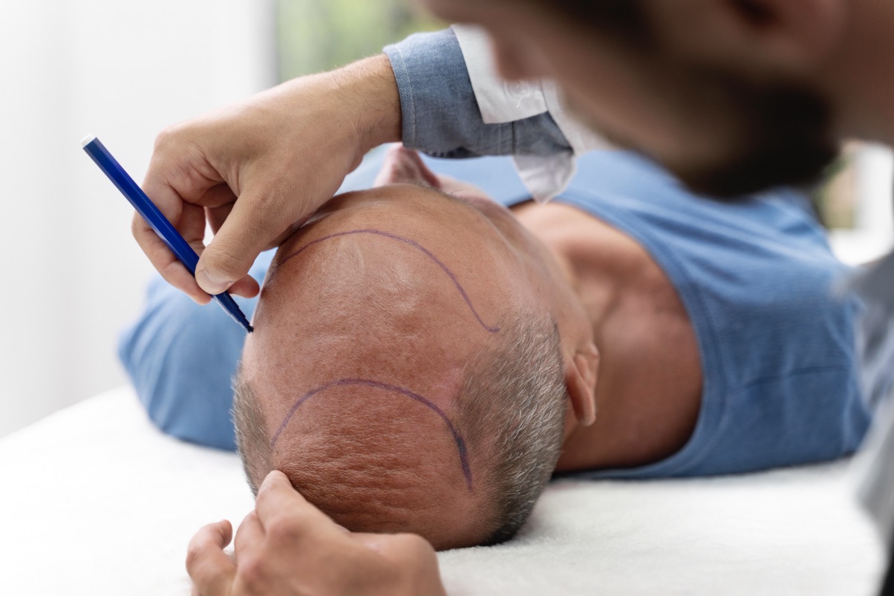 Is Turkey Still the Best Destination for Hair Transplant in 2025?