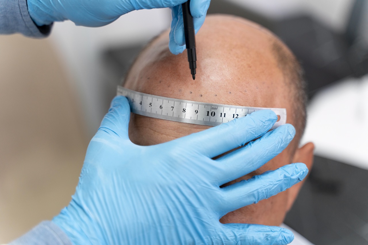 FUE vs. DHI Hair Transplant Methods