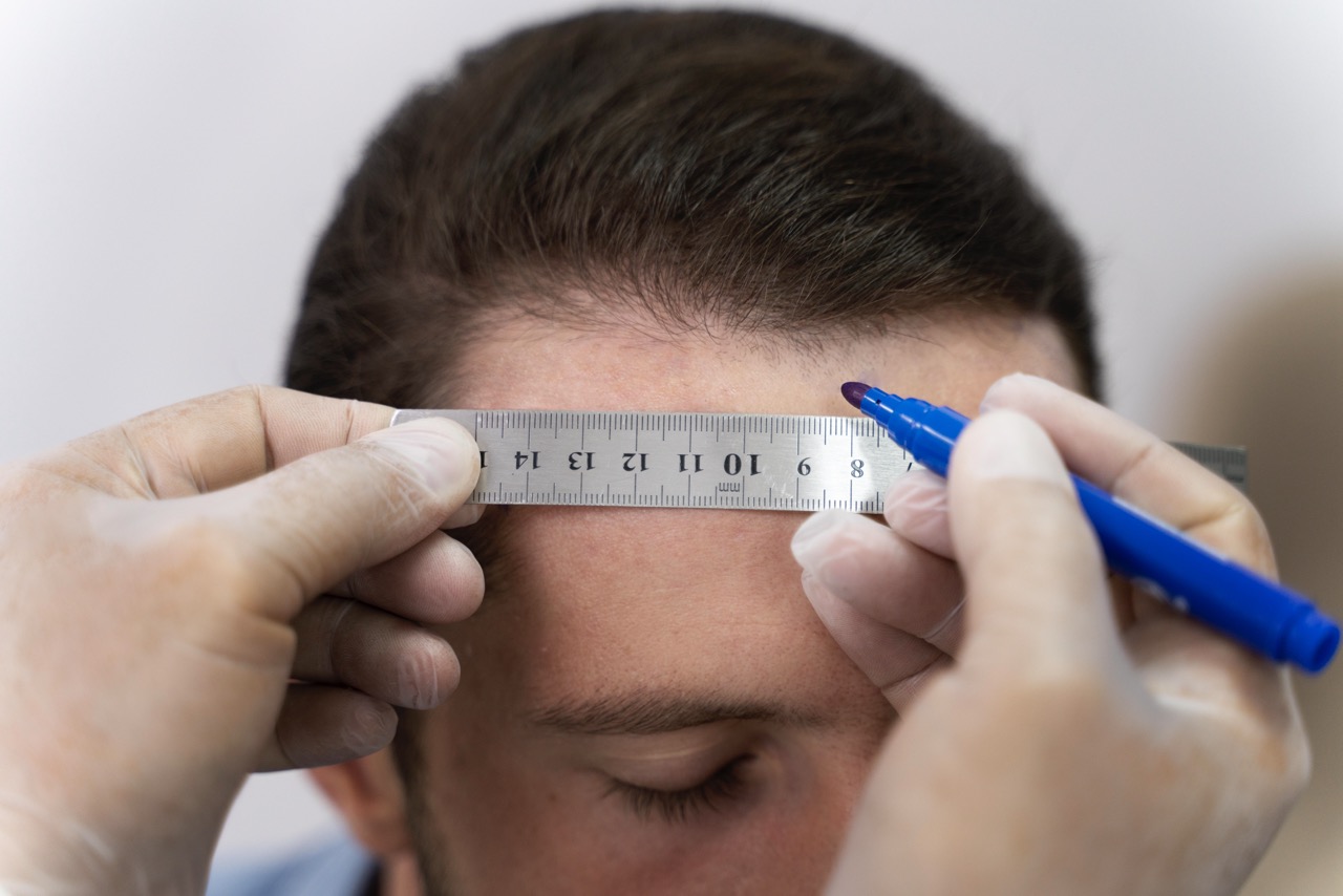 How to Minimize Scarring After a Hair Transplant