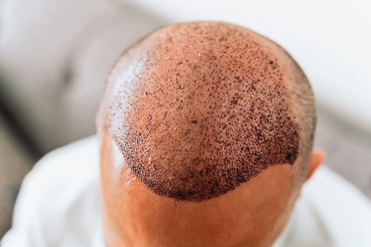 Best Age for a Hair Transplant: What Experts Recommend