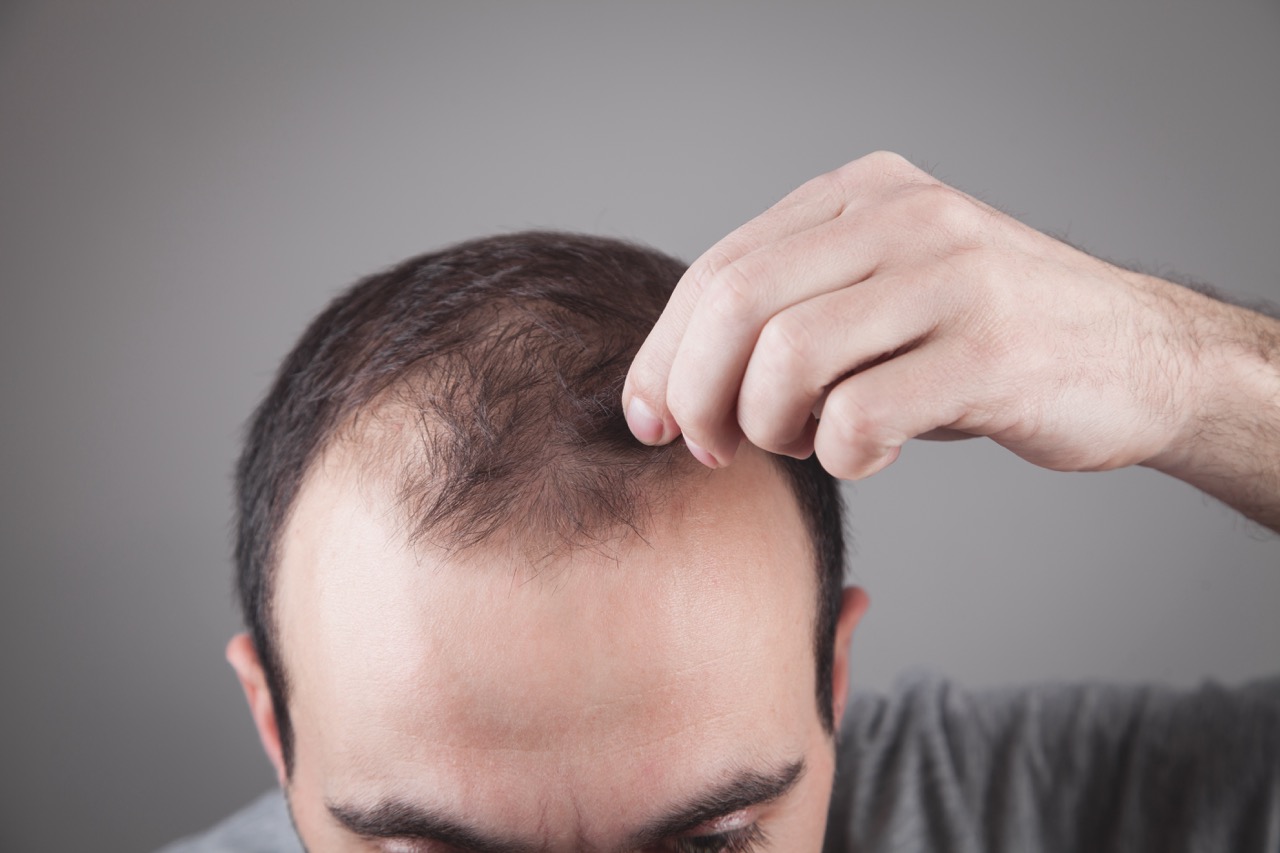 Hair Transplant and Smoking – Why You Should Quit