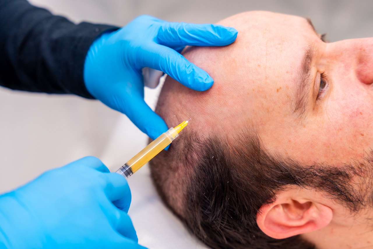 Hair Transplant for Burn Scars or Injuries – Is It Safe?