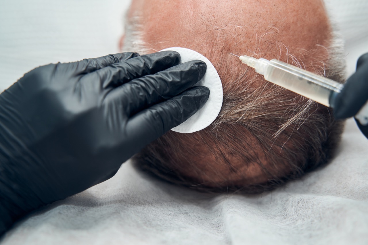 Hair Transplant for African Hair Type: What You Need to Know