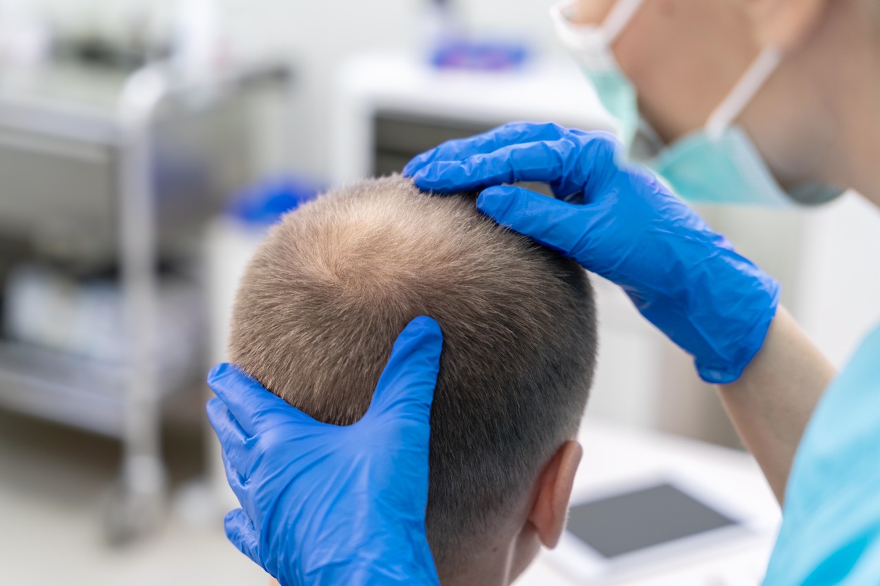 Beard and Mustache Transplant in Turkey: A Complete Guide