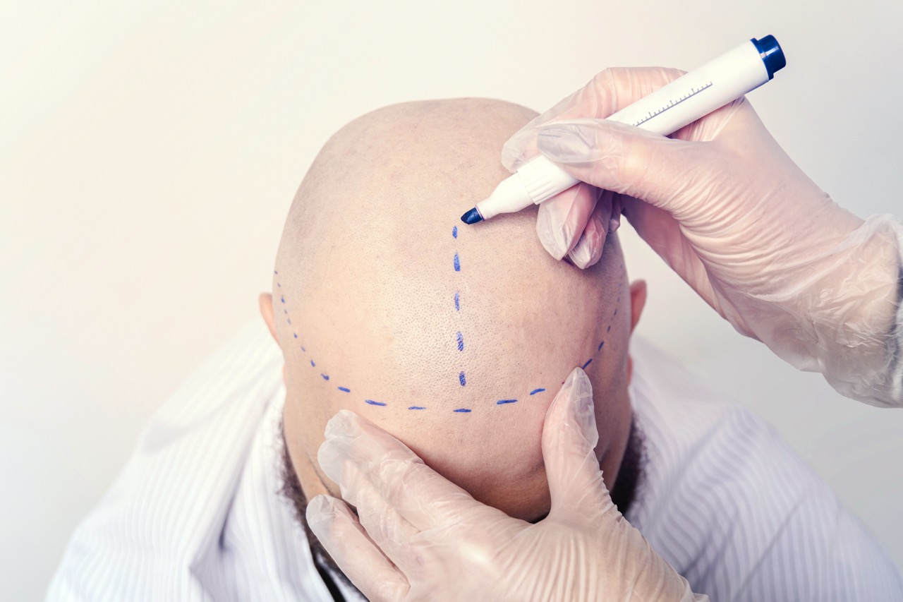 FUE vs. DHI: Which Hair Transplant Technique Is Right for You?